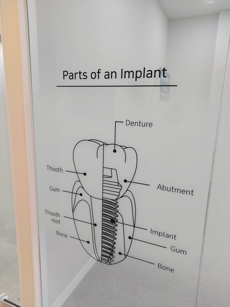 #유플란트치과#유플란트치과#청주#